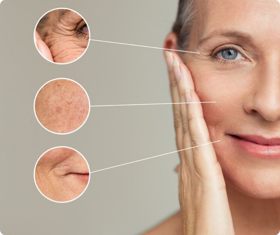 Dấu hiệu lão hóa da bắt đầu xuất hiện như nếp nhăn ở mắt, khóe miệng cùng với tàn nhang ở má