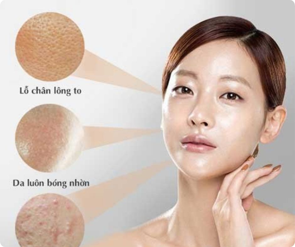 Tình trạng da tiết quá nhiều dầu, dẫn đến hiện tượng bóng nhờn khó chịu khiến lỗ chân lông to và hình thành mụn ẩn sâu bên trong