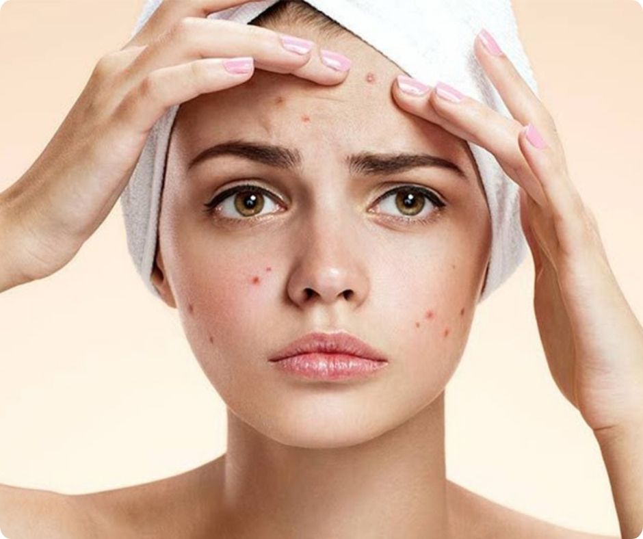 da mặt bị mụn đỏ và mụn viêm cần điều trị chăm sóc da