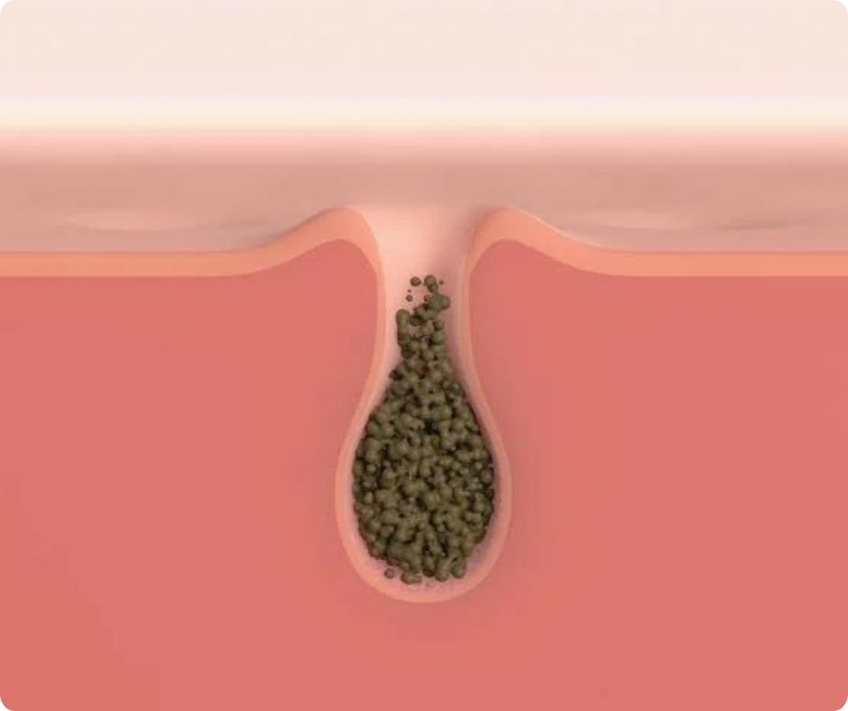 do đặc điểm tiết dầu thừa nhiều hơn so với các loại da khác, làn da dầu có xu hướng gặp phải tình trạng lỗ chân lông bị tắc nghẽn một cách thường xuyên