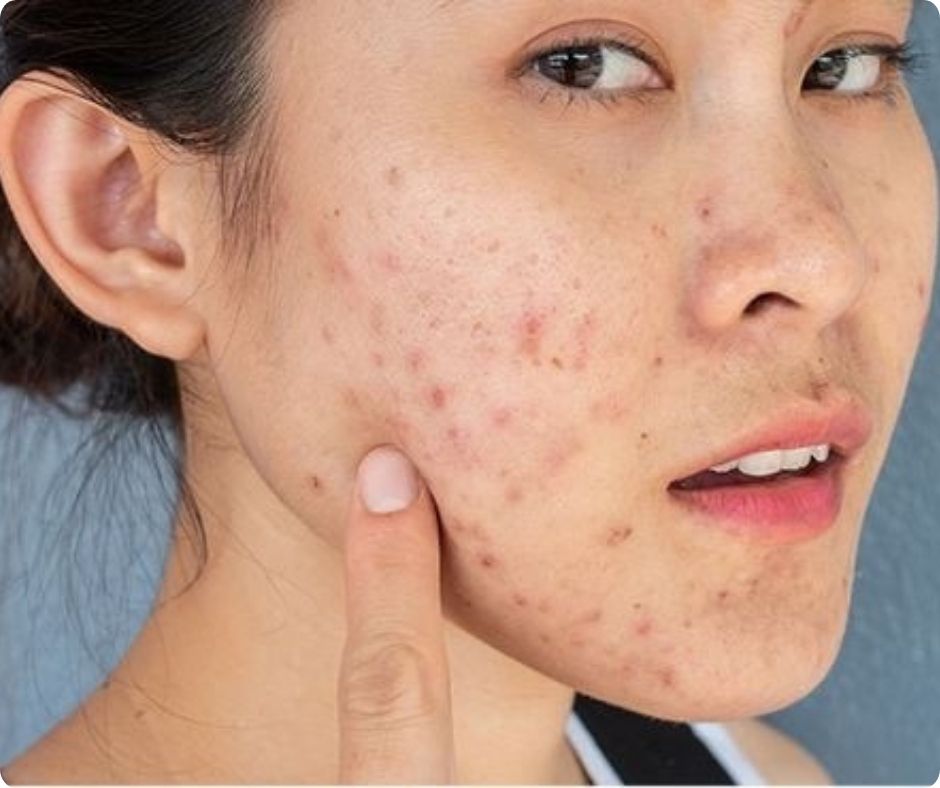 việc sử dụng kem dưỡng ẩm vào chu trình dưỡng da đã mang lại hiệu quả, giúp tình trạng mụn viêm và mụn ẩn trên da được cải thiện và ổn định hơn rất nhiều